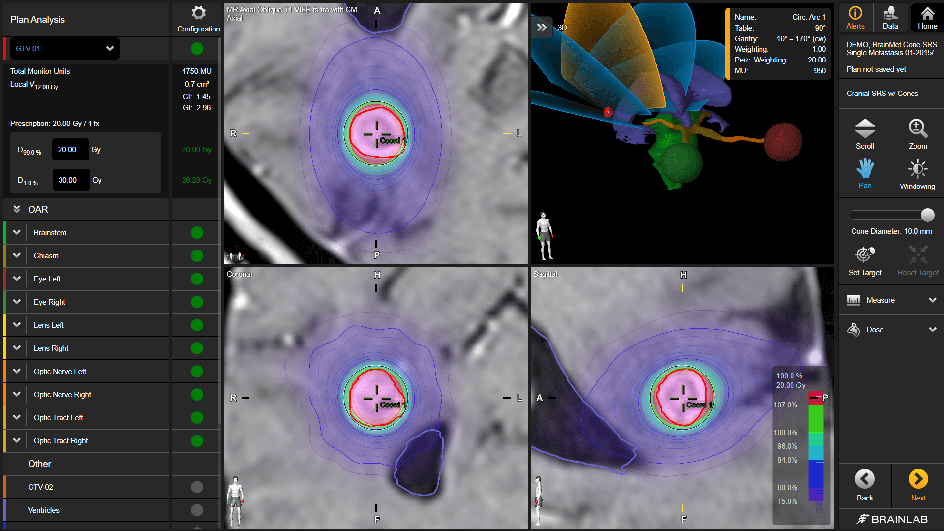 Software screen showing arc placement optimization during radiotherapy treatment planning which is intended to spare organs at risk from radiation 