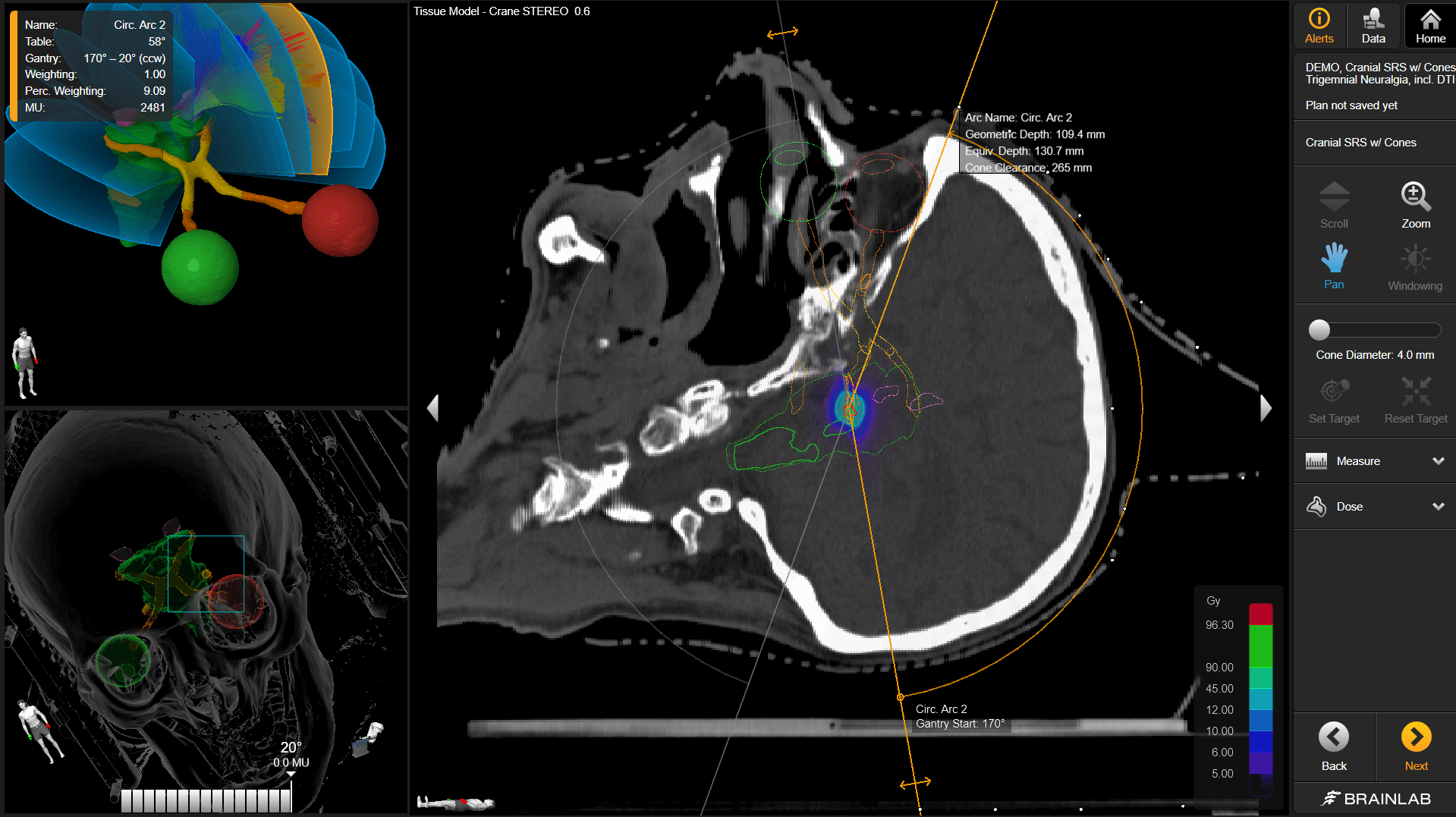 颅脑放射治疗计划中脑部的不同平面图，显示治疗的不同角度和元素。