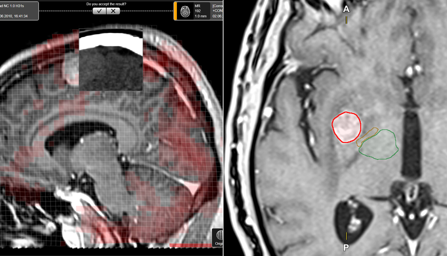 Screenshot zeigt die Ansichten und Daten, die mit den Elements Softwareapplikationen für die Radiotherapie- und Radiochirurgie-Behandlungsplanung verfügbar sind.