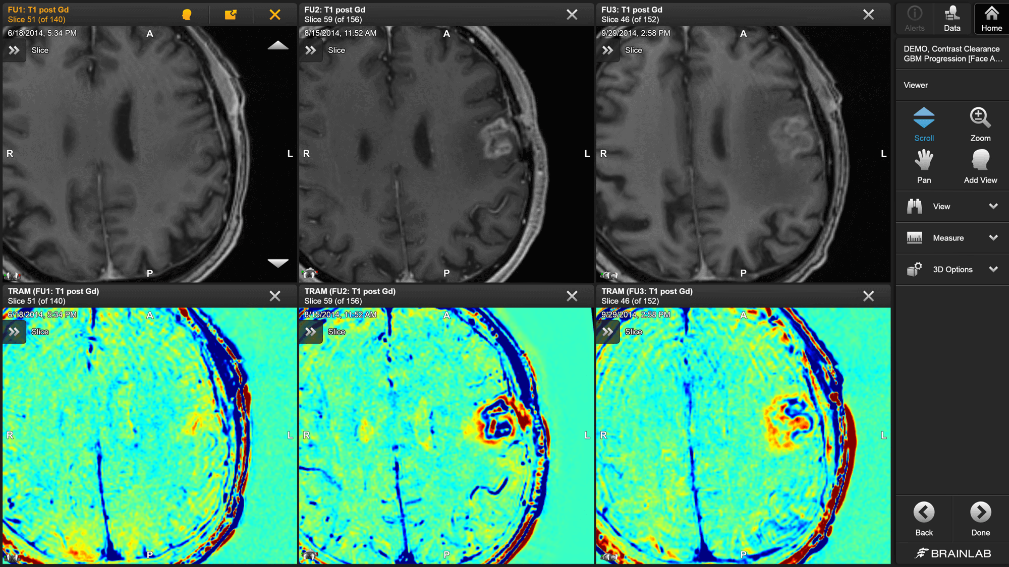 Trois images IRM en noir et blanc d’un cerveau prises à trois intervalles différents au-dessus des trois images Contrast Clearance Analysis correspondantes qui montrent l’évolution après ablation des tumeurs cérébrales d’un patient.