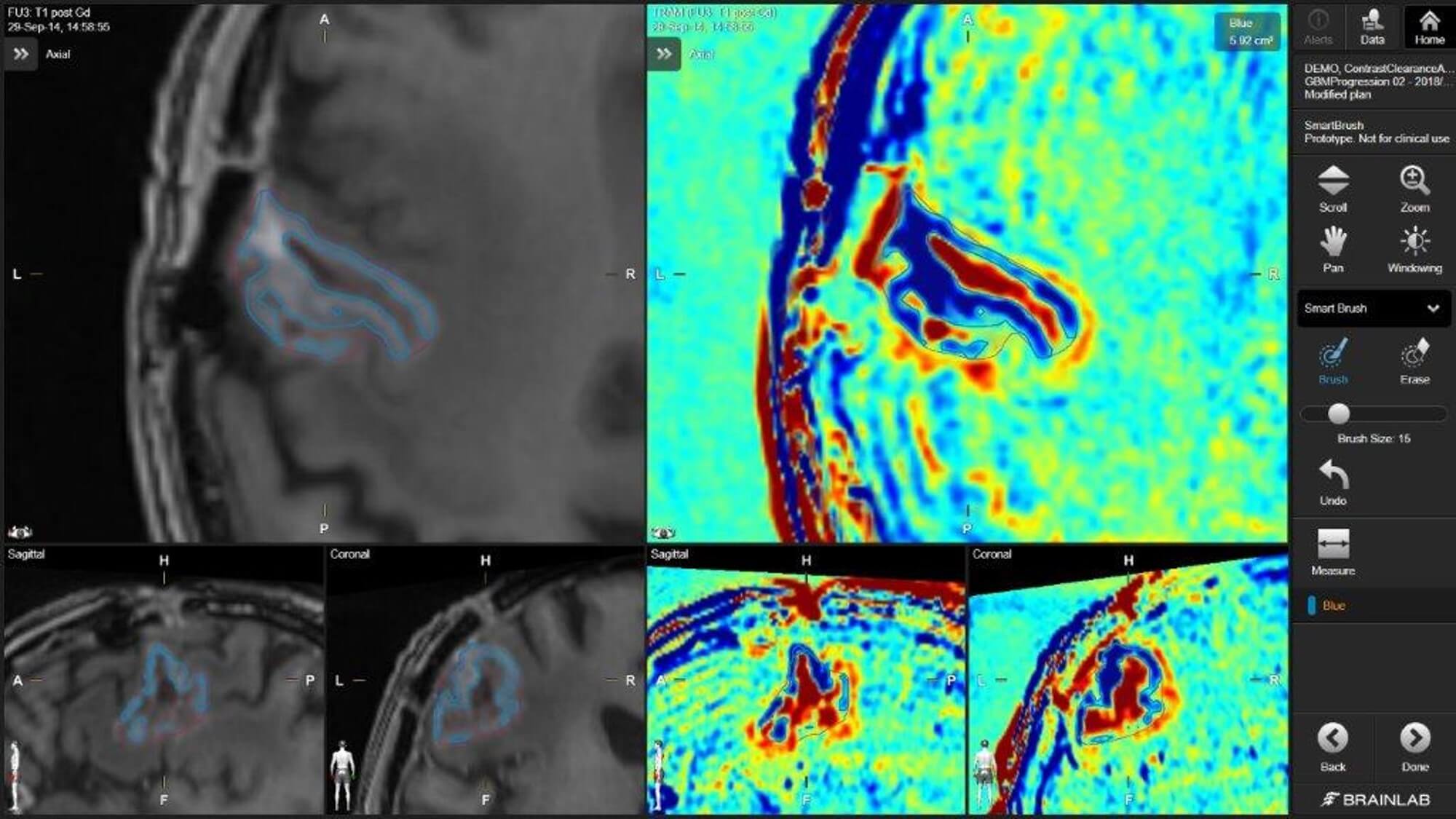 Images IRM d’un cerveau présentées côte à côte, à gauche en noir et blanc et à droite en couleurs, qui montrent la différence de clairance du produit de contraste par les tissus cérébraux.