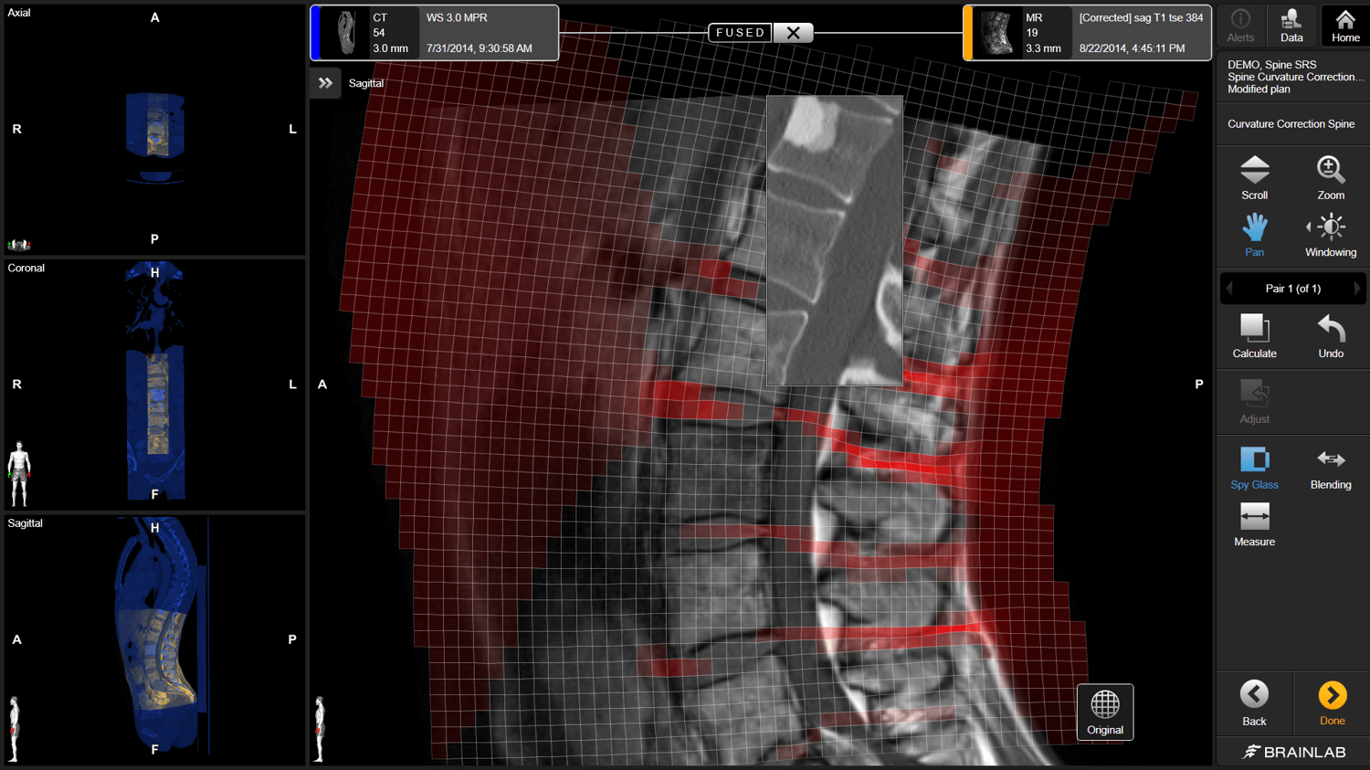这是 Elements Curvature Correction 的软件截图，将 CT 和 MR 图像融合来矫正成像时脊柱位置的差异。
