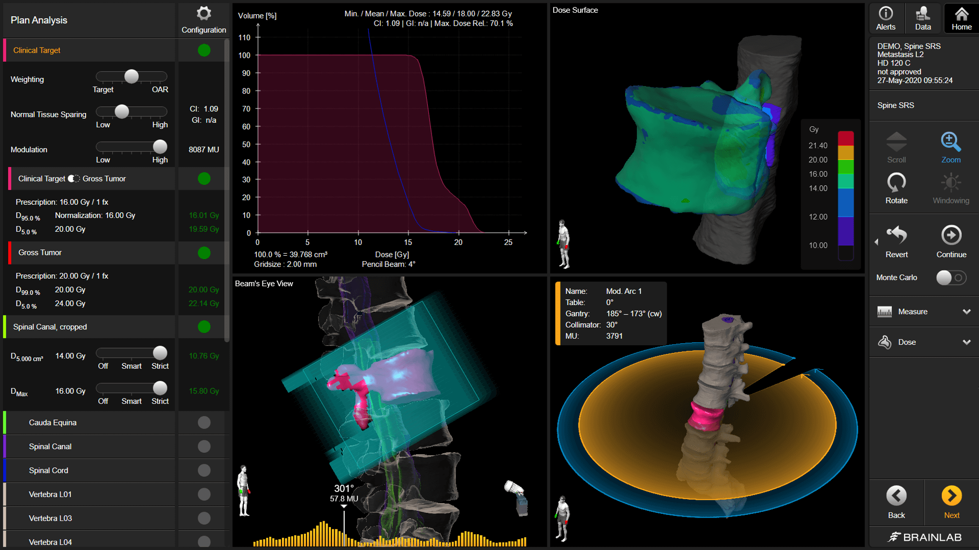 Capture d’écran du logiciel Element Spine SRS et des divers outils qu’il propose pour visualiser la dose créée pour un plan de radiothérapie.
