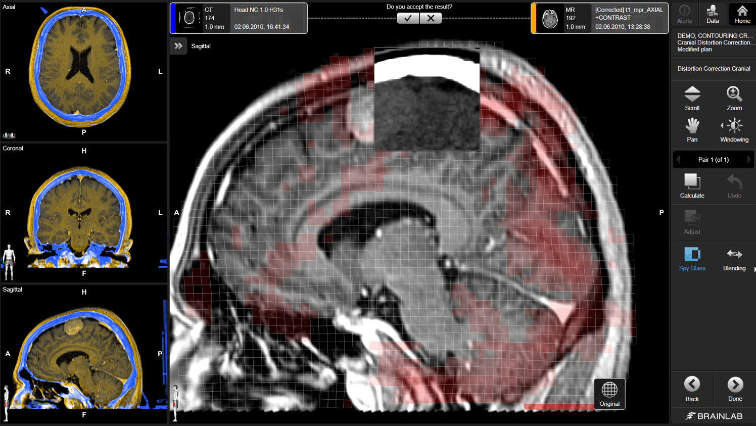 Tela do software Brainlab Elements Distortion Correction, que exibe uma imagem de RM e de tomografia de um cérebro durante a correção de distorções na fusão daquela imagem.
