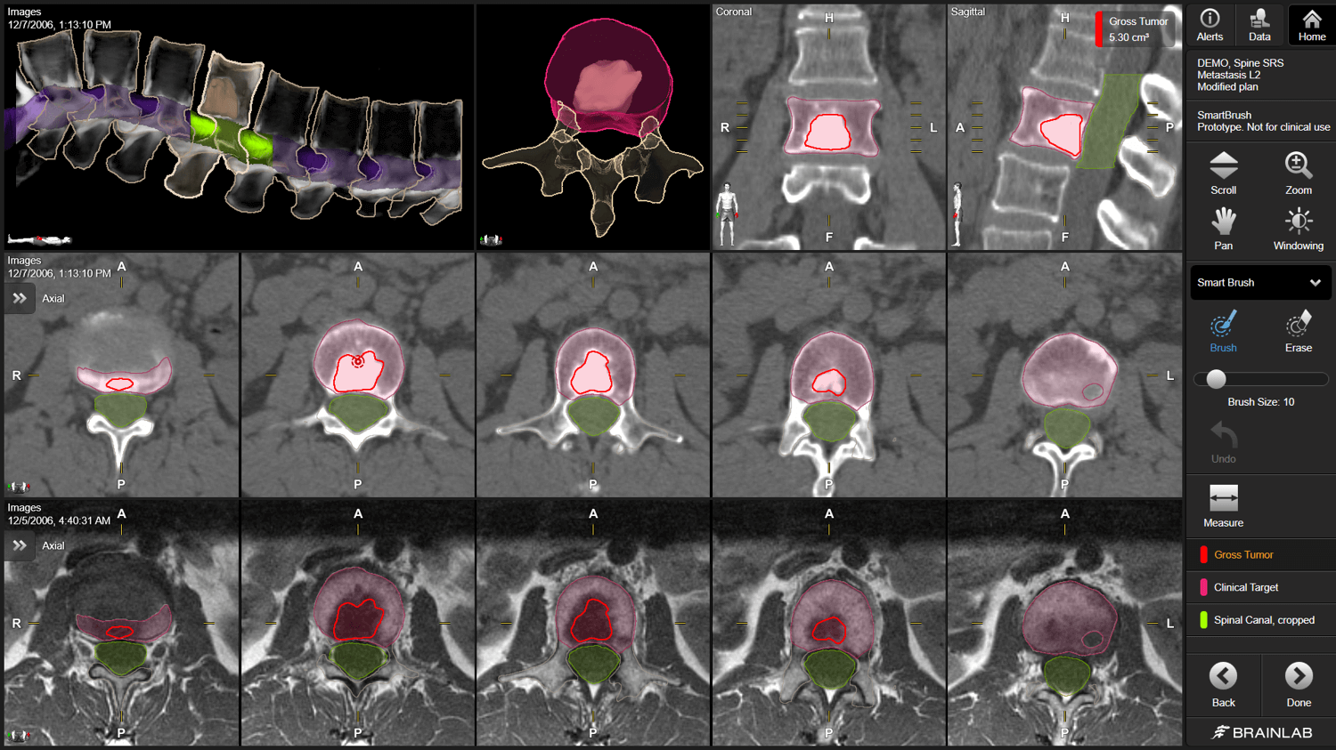 Software screenshot of Elements SmartBrush software as used for segmenting parts of the spine for a spinal radiotherapy treatment.