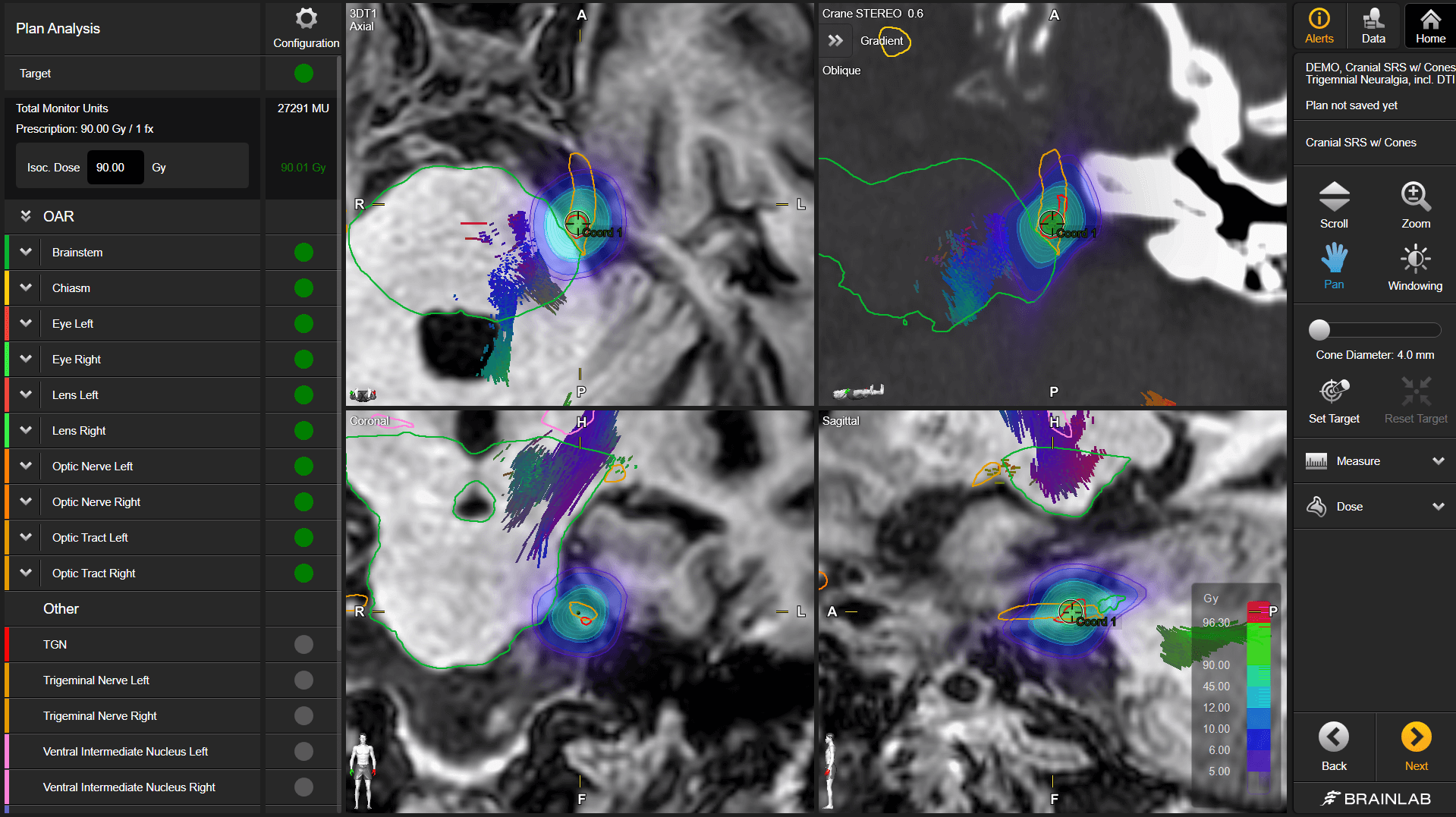 Tela do software Fibertracking mostrando uma aquisição do cérebro em preto e branco e de tratos fibrosos em cores, usada para otimizar o planejamento do tratamento radioterápico.