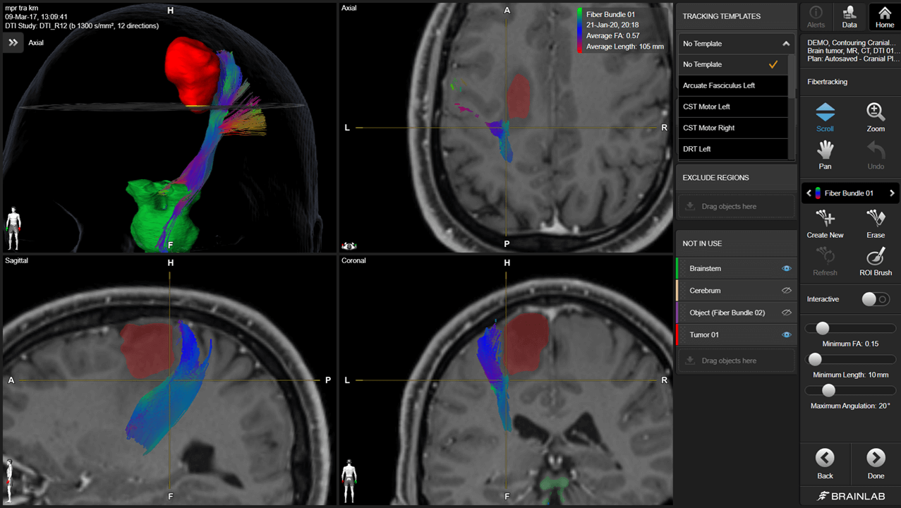 Software screen showing a brain in black and white and the brain's fiber tracts in color to assist with the planning of radiotherapy treatments.