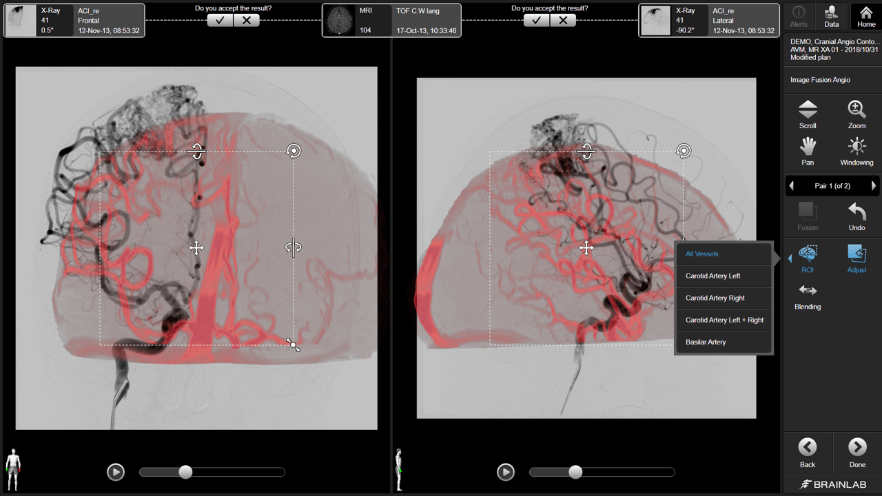 Capture d’écran du logiciel montrant le co-référencement unique de données DSA 2D par rapport à des données 3D pour la planification de traitements de radiothérapie vasculaire crânienne.