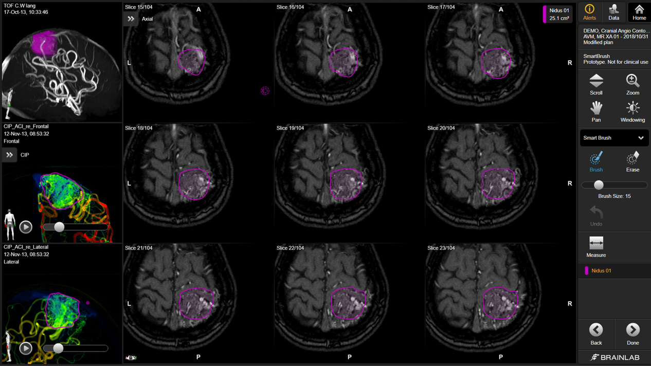 Screenshot der Brainlab Elements Angio-Software, die auf unterschiedlichste Weise in der kranial vaskulären Radiotherapie-Bestrahlungsplanung eingesetzt wird.