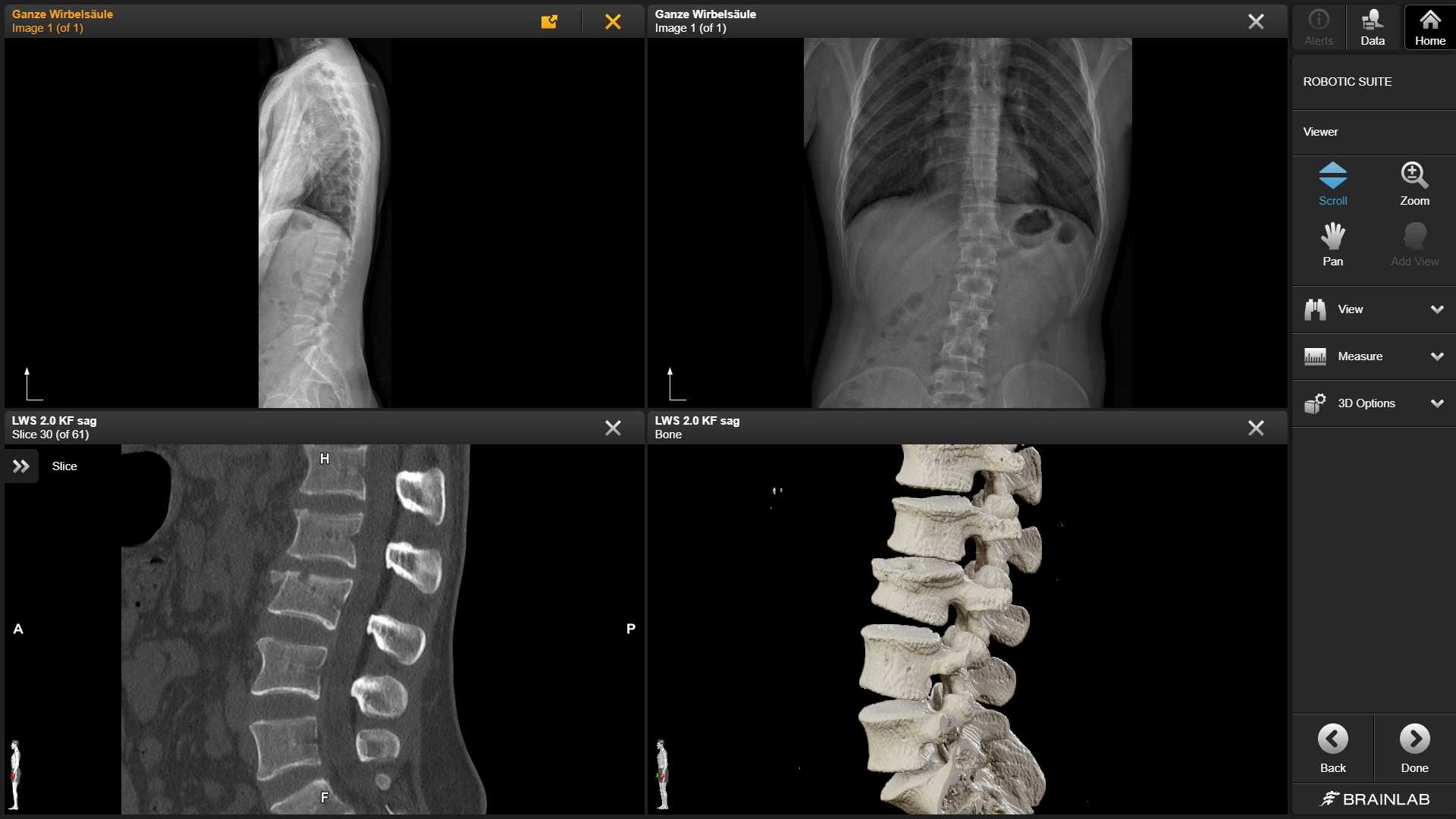 在 Elements Viewer 软件中，使用一个由四个不同的颅骨扫描和 3D 绘制视图组成的网格来制定颅颌面手术计划。