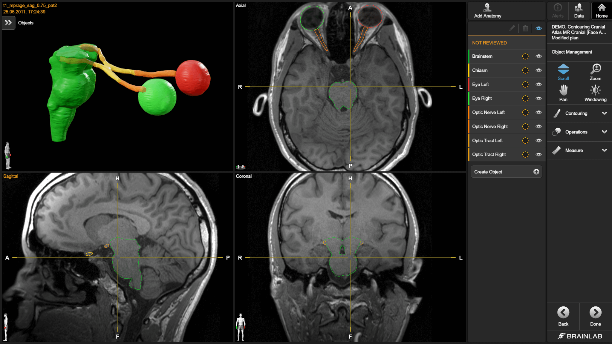 Anatomical Mapping 软件界面，用于分割脑部的不同结构以进行放疗计划。