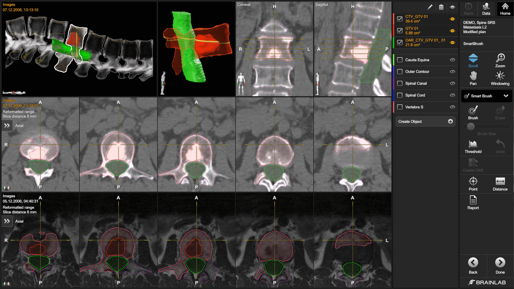 Screenshot der Elements SmartBrush-Software, die zur Segmentierung der Wirbelsäule für die spinale Radiotherapie-Behandlung eingesetzt wird.