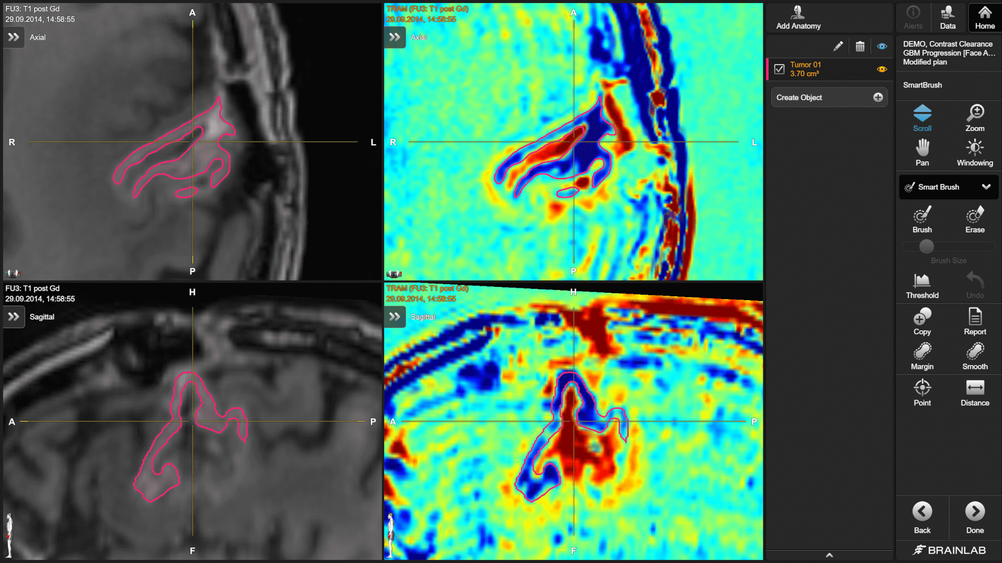 Images IRM d’un cerveau présentées côte à côte, à gauche en noir et blanc et à droite en couleurs, qui montrent la différence de clairance du produit de contraste par les tissus cérébraux.