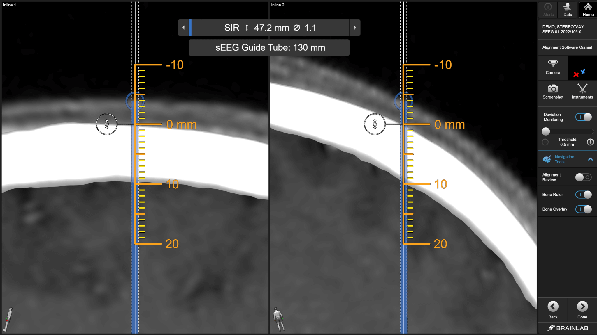 Capture d’écran du logiciel Elements Curvature Correction après fusion des images TDM et IRM pour corriger les différences de position du rachis en cours d’imagerie.